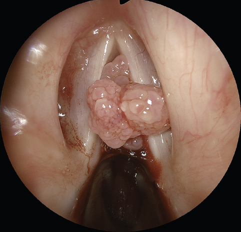 Endoscopic image showing the classical appearance of pedunculated papilloma attached to the right true vocal cord.